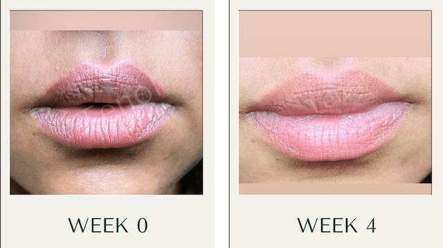 Two - Step Intensive Resurfacing & Correction Lip System - Tenol™ -