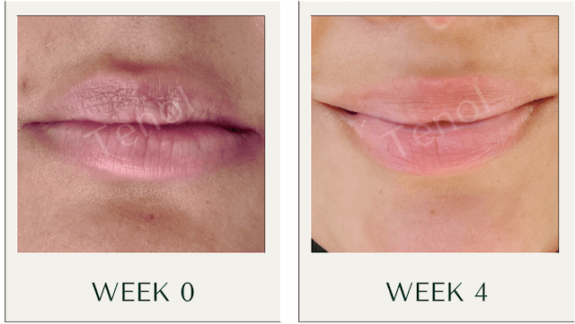 Two - Step Resurfacing & Corrective Lip Renewal System - Tenol™ - Two - Step Lip Treatment