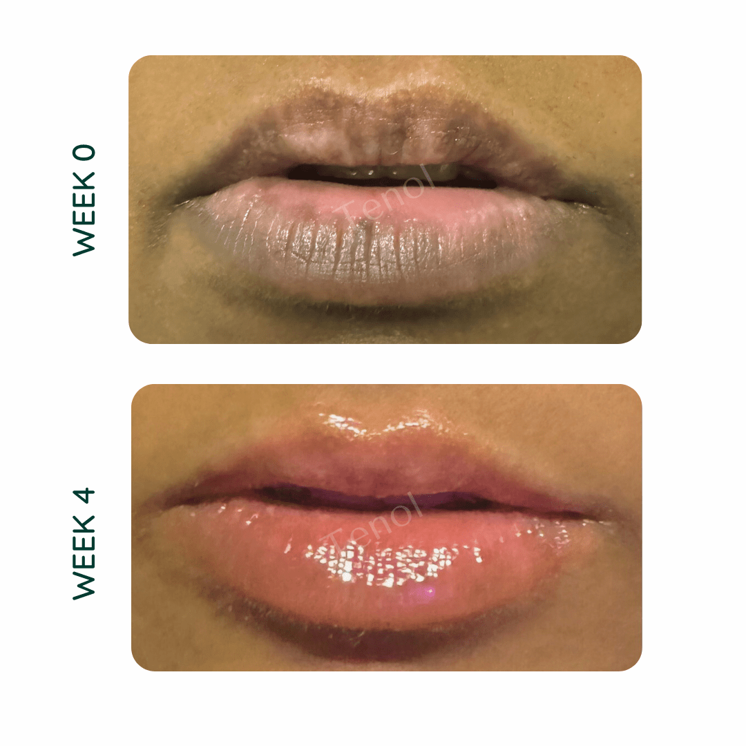 Lip Remedy Xtreme | Intensive Treatment for Severe Lip Discolouration - Tenol™ - Lip Remedy
