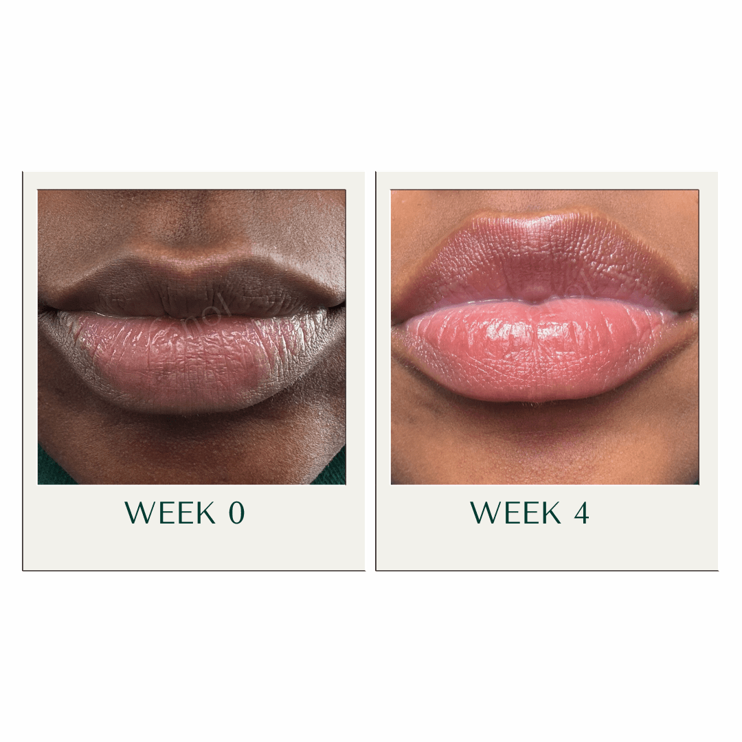 Lip Remedy Original | For Moderate Lip Discolouration - Tenol™ - Lip Remedy