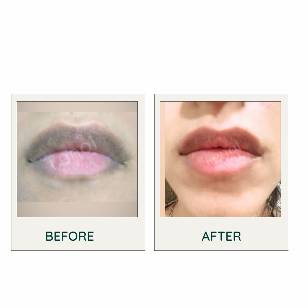 Tenol Lip Remedy Kit - Lip Remedy Balm and Lip Exfoliator Gel