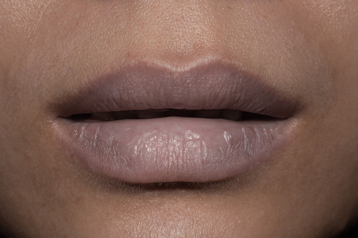 What causes lip hyperpigmentation?