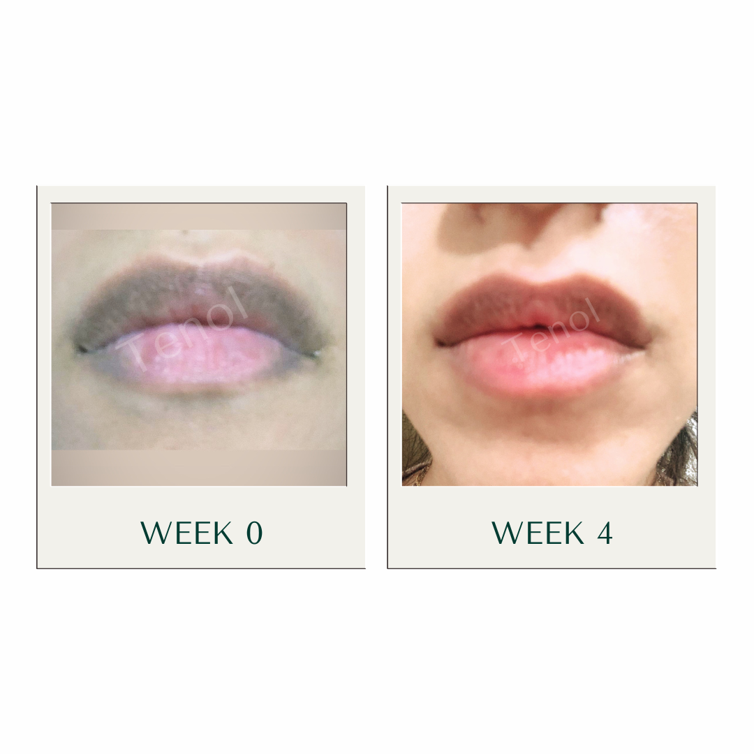 Tenol Lip Remedy Kit (Regular Strength Kit) Reverse Lip Hyperpigmentation and Repair Lips