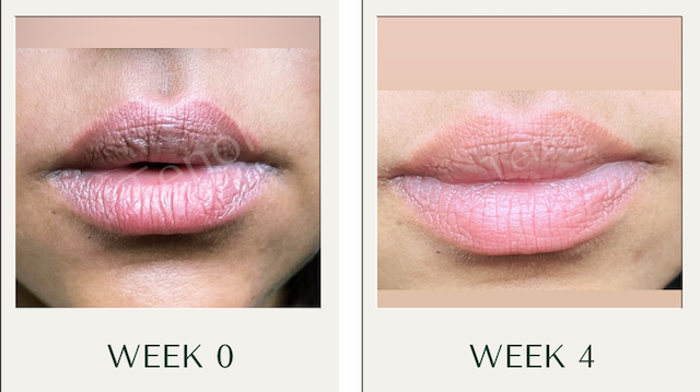 Two-Step Intensive Resurfacing & Correction Lip System