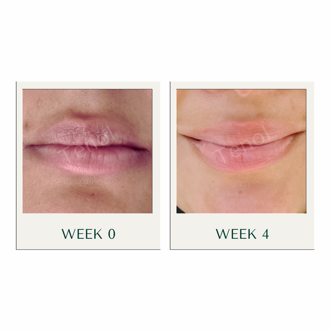 Lip Remedy Xtreme (High Strength) -  Treatment for Severe Lip Discolouration (Ideal for Smokers)