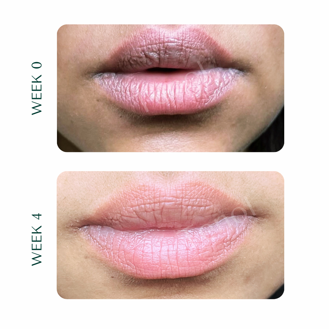 Tenol Lip Remedy Kit (Regular Strength Kit) Reverse Lip Hyperpigmentation and Repair Lips