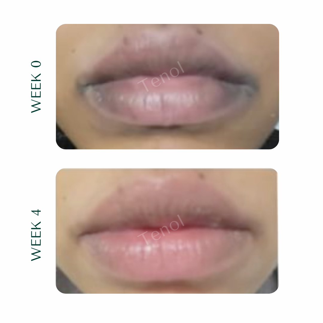 Tenol Lip Remedy (Regular Strength)