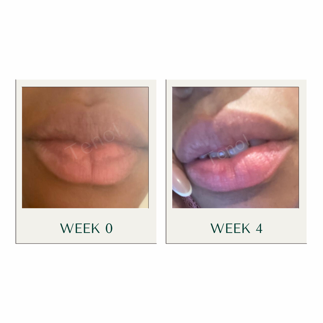 Tenol Lip Remedy Kit (Regular Strength Kit) Reverse Lip Hyperpigmentation and Repair Lips