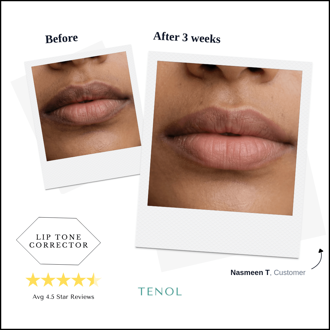 Lip Remedy Original | For Moderate Lip Discolouration - Tenol™ - Lip Remedy