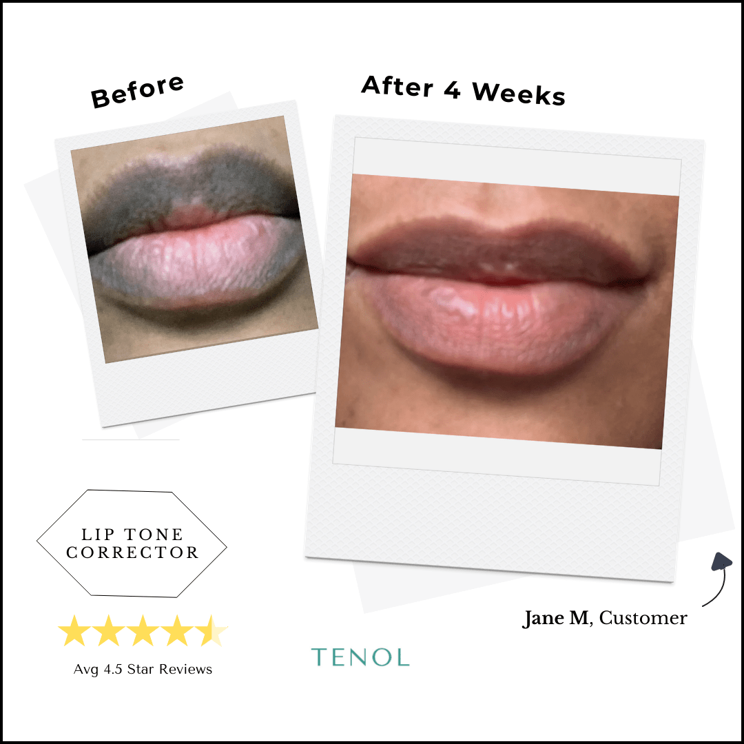 Lip Remedy Xtreme | Intensive Treatment for Severe Lip Discolouration - Tenol™ - Lip Remedy