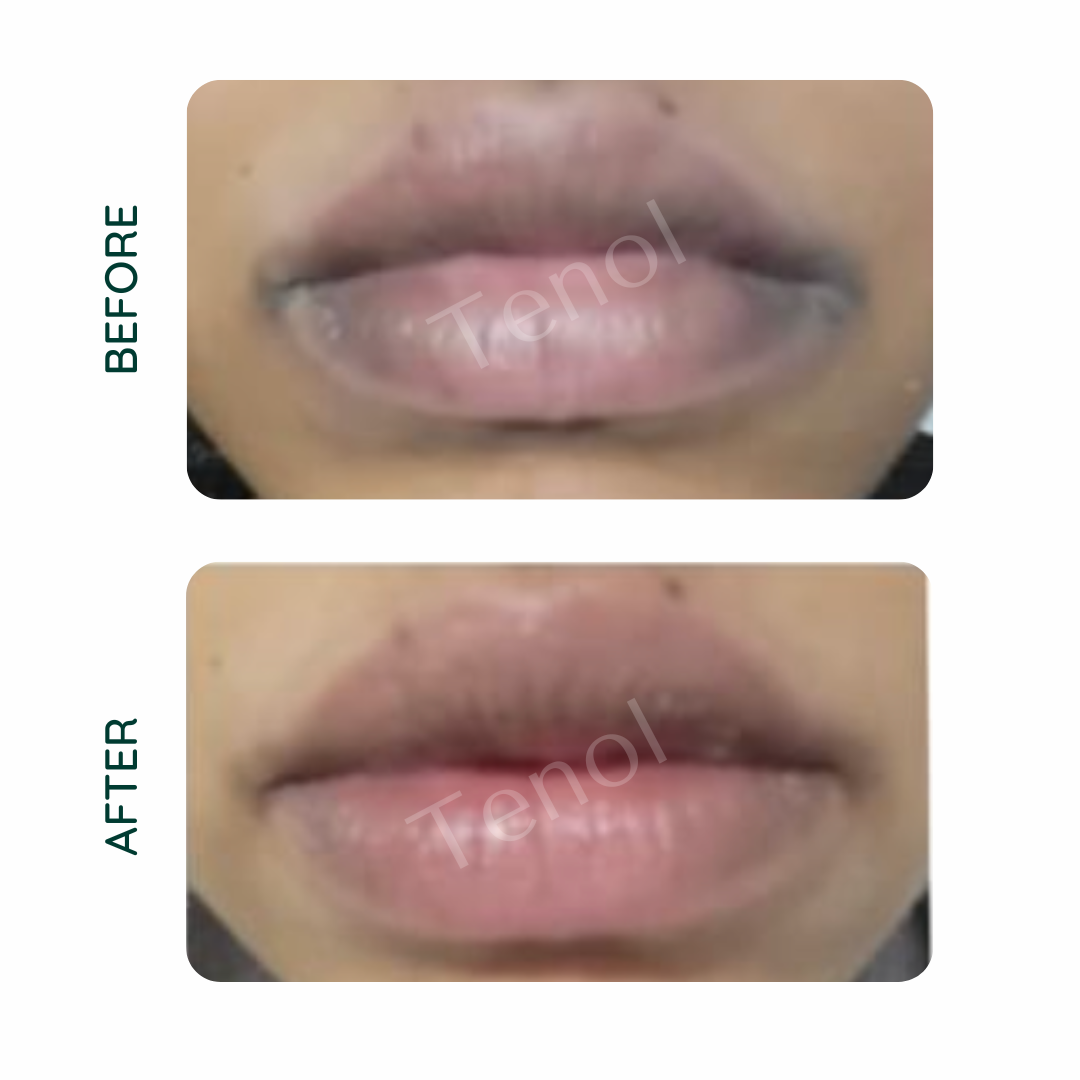 Tenol Lip Remedy Balm - Traitement pour l'hyperpigmentation / décoloration des lèvres 