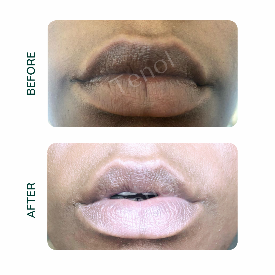 Tenol Lip Remedy Kit - Hyperpigmentation inversée des lèvres et réparation des lèvres 