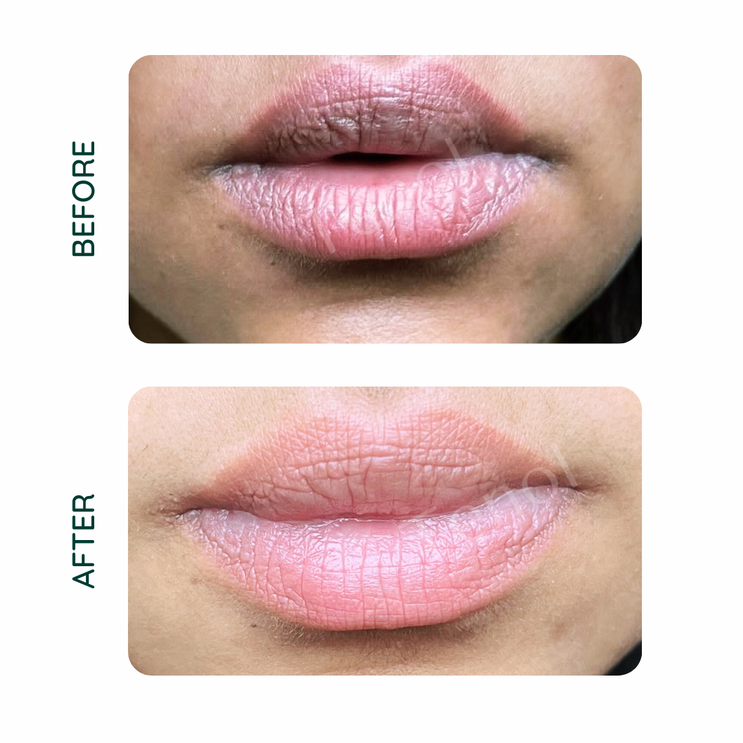Tenol Lip Remedy Kit - Reverse Lip Hyperpigmentation and Repair Lips