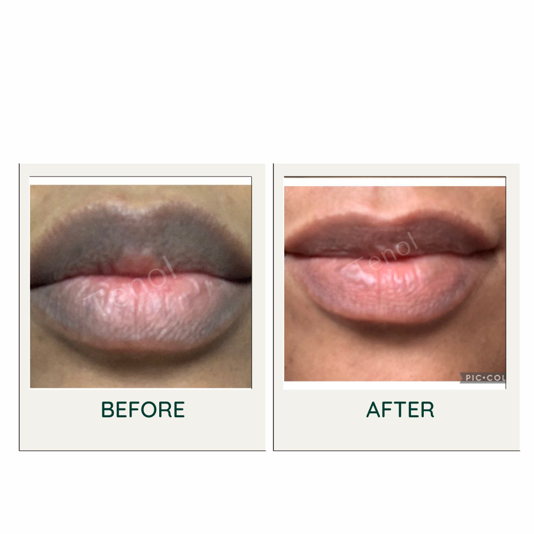Tenol Lip Remedy Balm - Traitement pour l'hyperpigmentation / décoloration des lèvres 